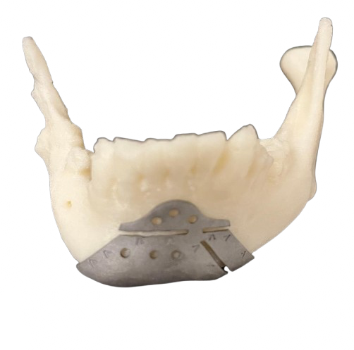 Genioplasty Cutting Guide