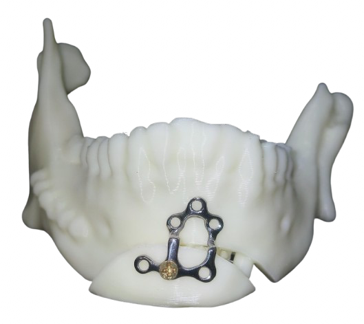 Genioplasty