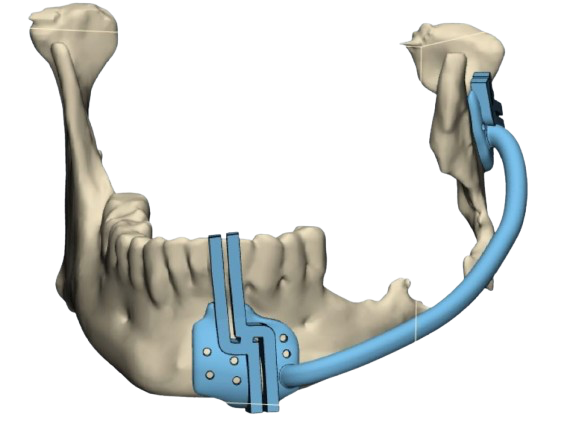 Mandible Cutting Guide