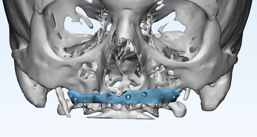 Maxilla Cutting Guides