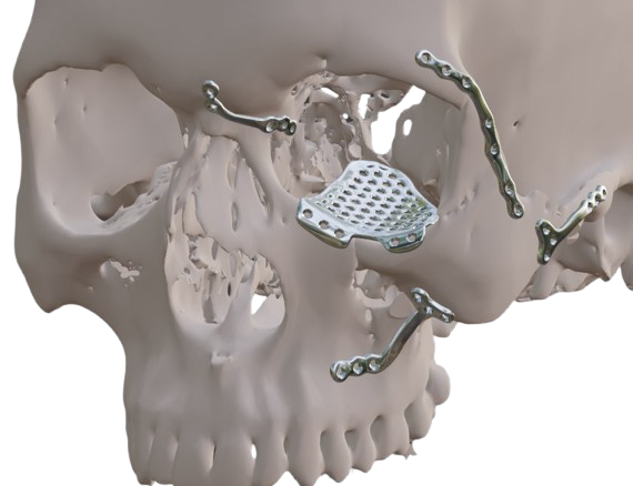 Orbitoplasty