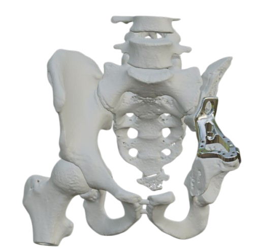 Pelvic Implants