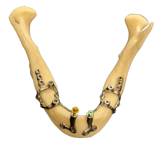 Subperiostal Implants